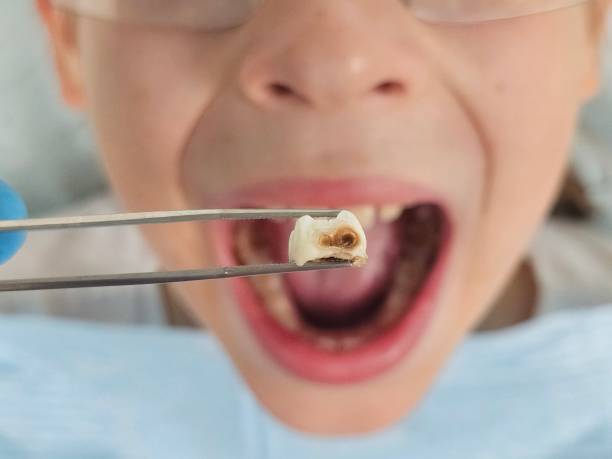 Best Broken or Cracked Tooth Emergency Dentist in Kyle, SD